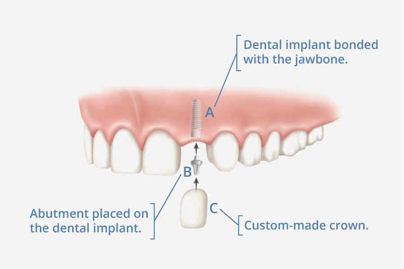  affordable dental implants